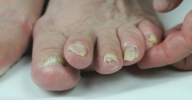 Onicomicosis