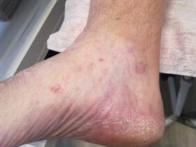Rubromicosis