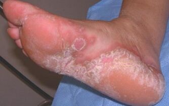 Dermatomicosis aguda do pé