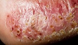Dermatomicosis