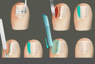 Eliminando a uña en presenza dun fungo nas pernas