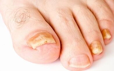 Síntomas fotográficos do fungo das uñas