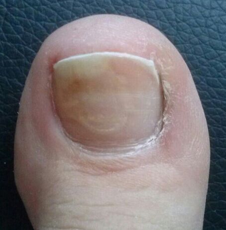 O fungo das uñas no polgar