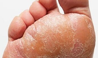 Signos e síntomas de fungo nas pernas