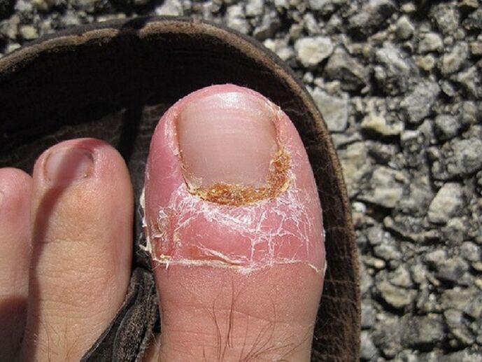 danos nas uñas e na pel dos dedos dos pés debido a unha infección fúngica